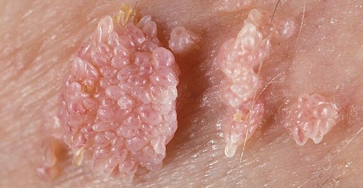 Milzu condyloma