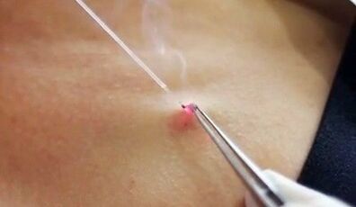 Papilloma noņemšana uz ķermeņa ar lāzeru