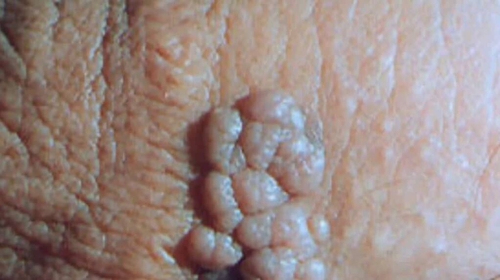 Asa condiloma