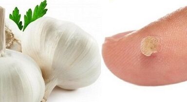 kārpu ārstēšana ar tautas līdzekļiem