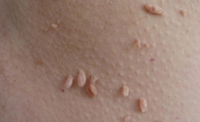 Papilomu parādīšanās iemesli cilvēka ķermenī