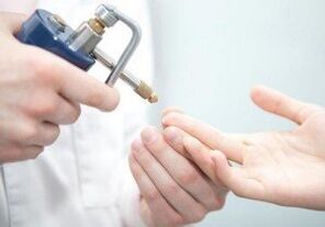 modernas papilomu noņemšanas metodes