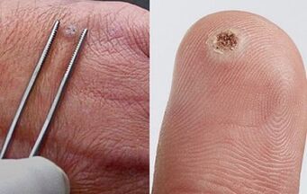 papilomu simptomi uz cilvēka ķermeņa