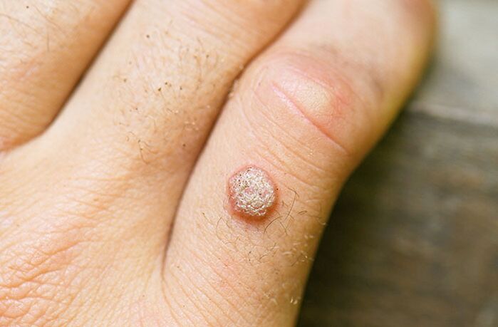 Inficējoties ar HPV, uz rokas vai citas ķermeņa daļas var parādīties kārpu